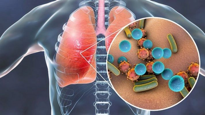Suy giảm miễn dịch khiến khả năng bảo vệ cơ thể bị suy giảm.