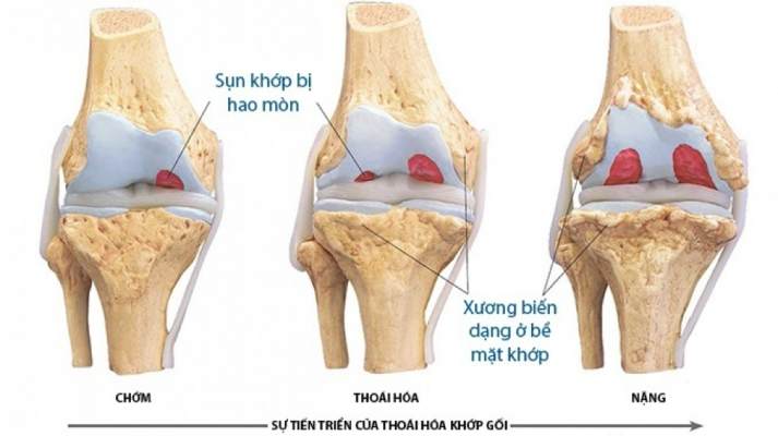 Quá trình thoái hoá khớp gối