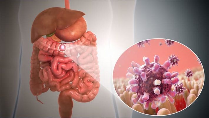 Viêm đại tràng do nhiễm khuẩn đường ruột