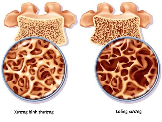 Thiếu vitamin D làm tăng nguy cơ loãng xương