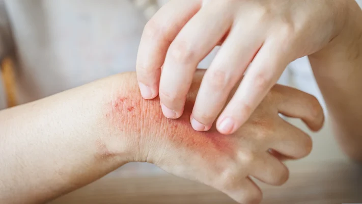 Thiếu vitamin D khiến cơ thể dễ mắc các bệnh nhiễm trùng