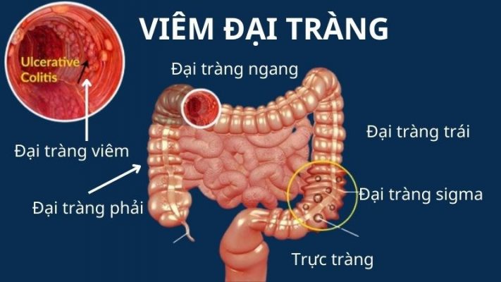 Viêm đại tràng là gì?